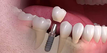 Straumann—Implant